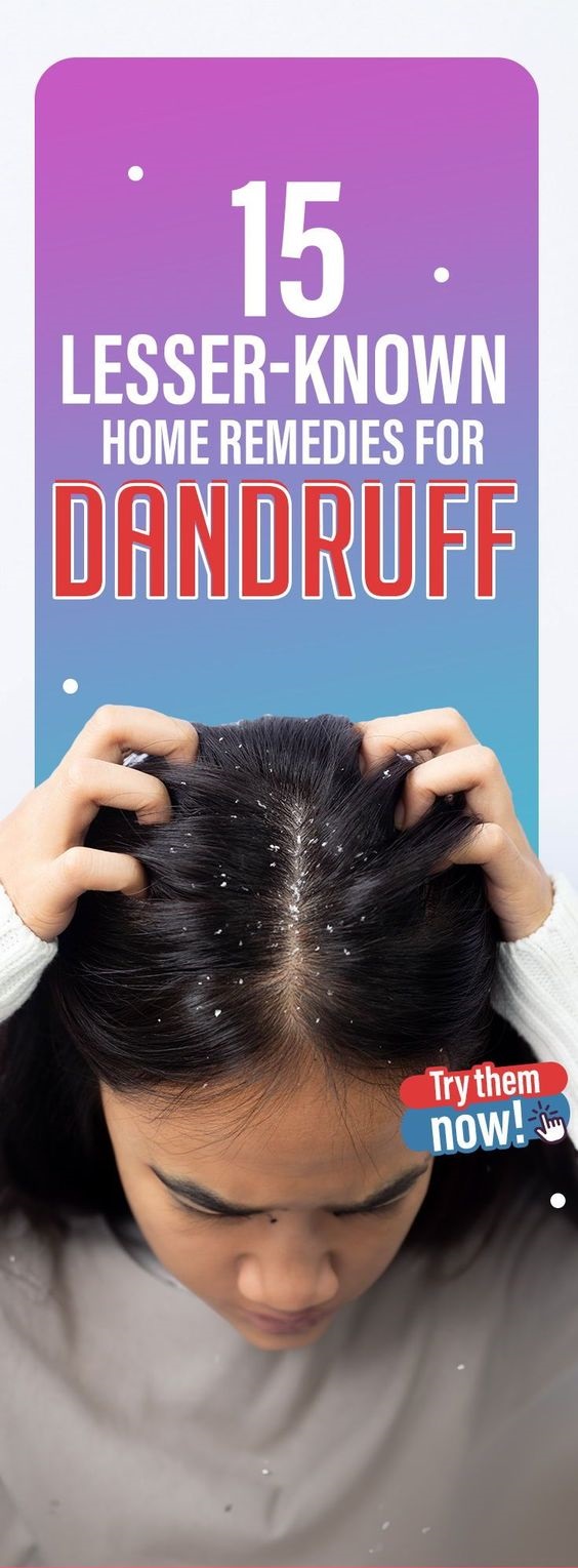15 Lesser-Known Home Remedies For Dandruff